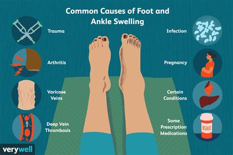 Why Amlodipine Causes Ankle Swelling and How to Reduce It